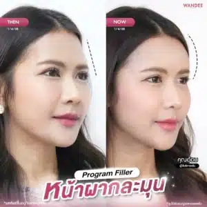 เสริมมิติหน้าผาก เติมความหวานให้ใบหน้า