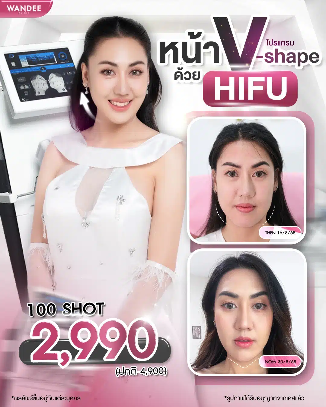 ตัวช่วยยกกระชับหน้า 𝗩-𝗦𝗵𝗮𝗽𝗲