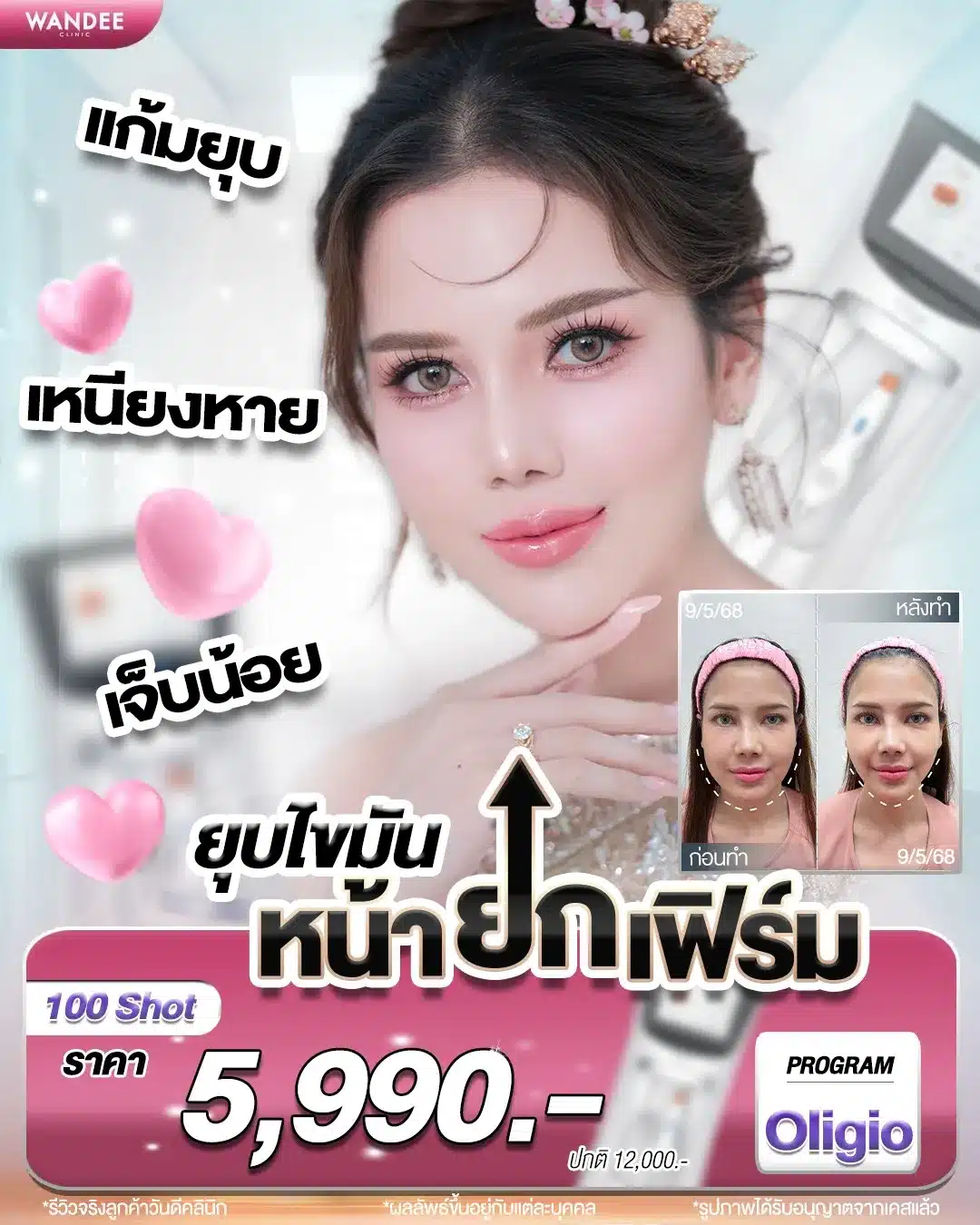 ยุบไขมัน! หน้ายกเฟิร์ม