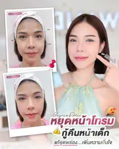 โปรแกรม 𝗙𝗶𝗹𝗹𝗲𝗿 ปรับครบทุกมิติ ขมับ หน้าแก้ม ใต้ตา