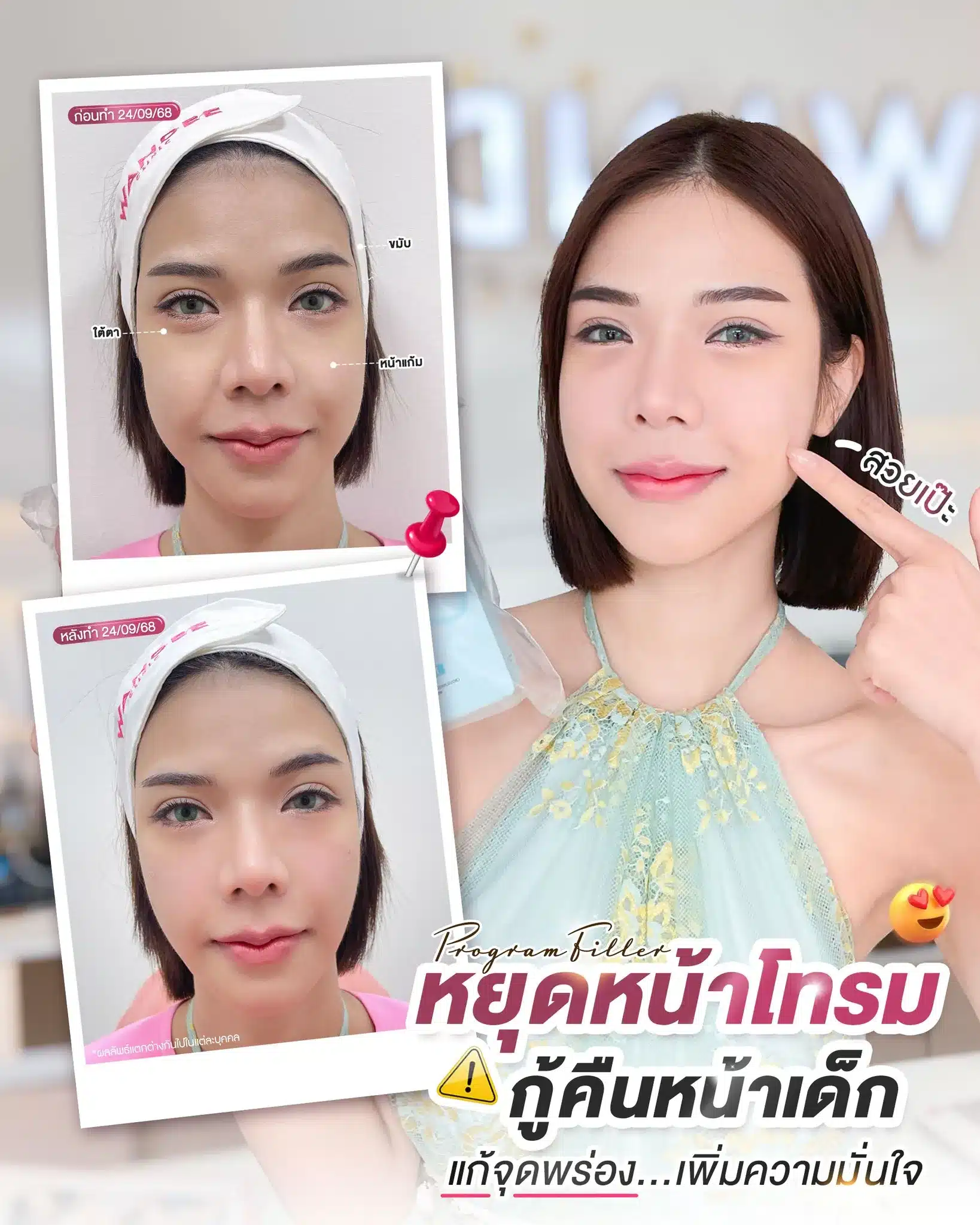 โปรแกรม 𝗙𝗶𝗹𝗹𝗲𝗿 ปรับครบทุกมิติ ขมับ หน้าแก้ม ใต้ตา