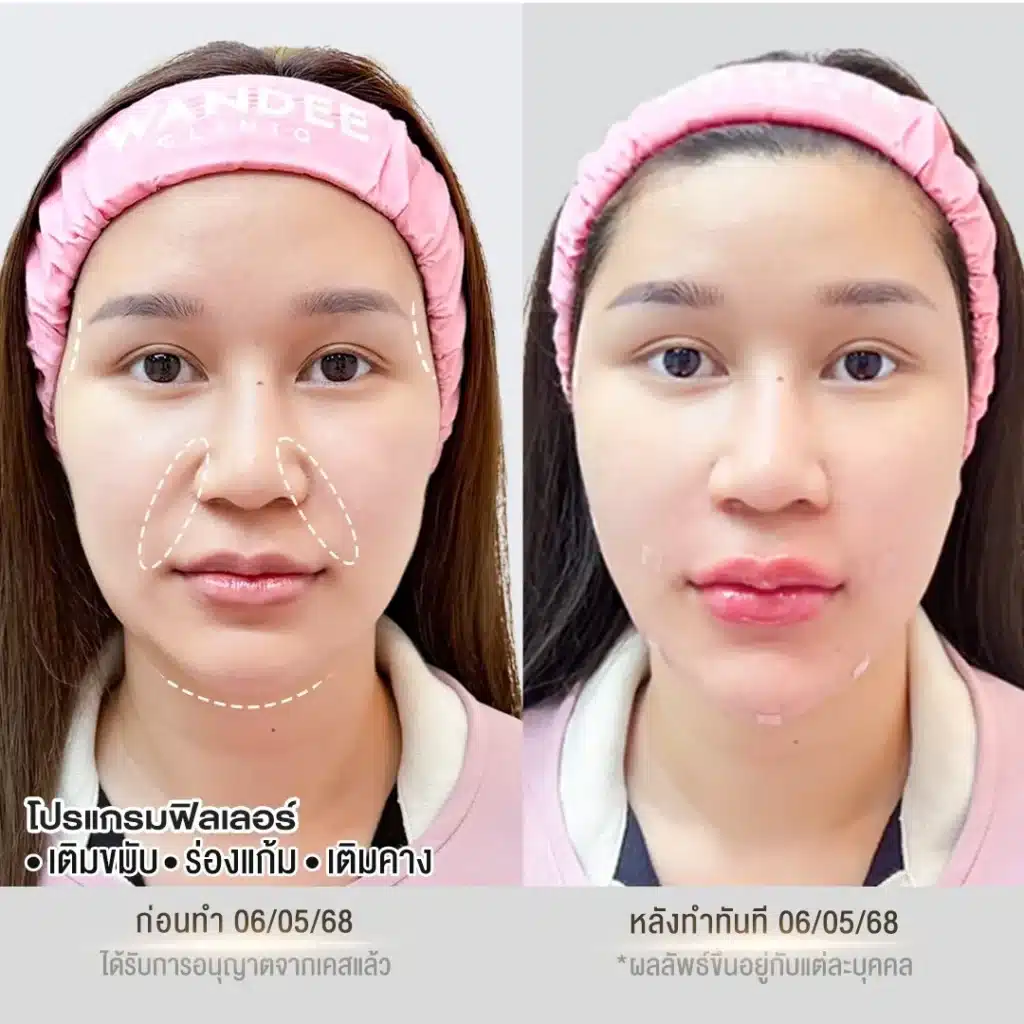 รีวิวฟิลเลอร์