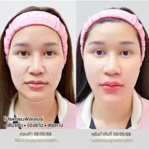 รีวิวฟิลเลอร์