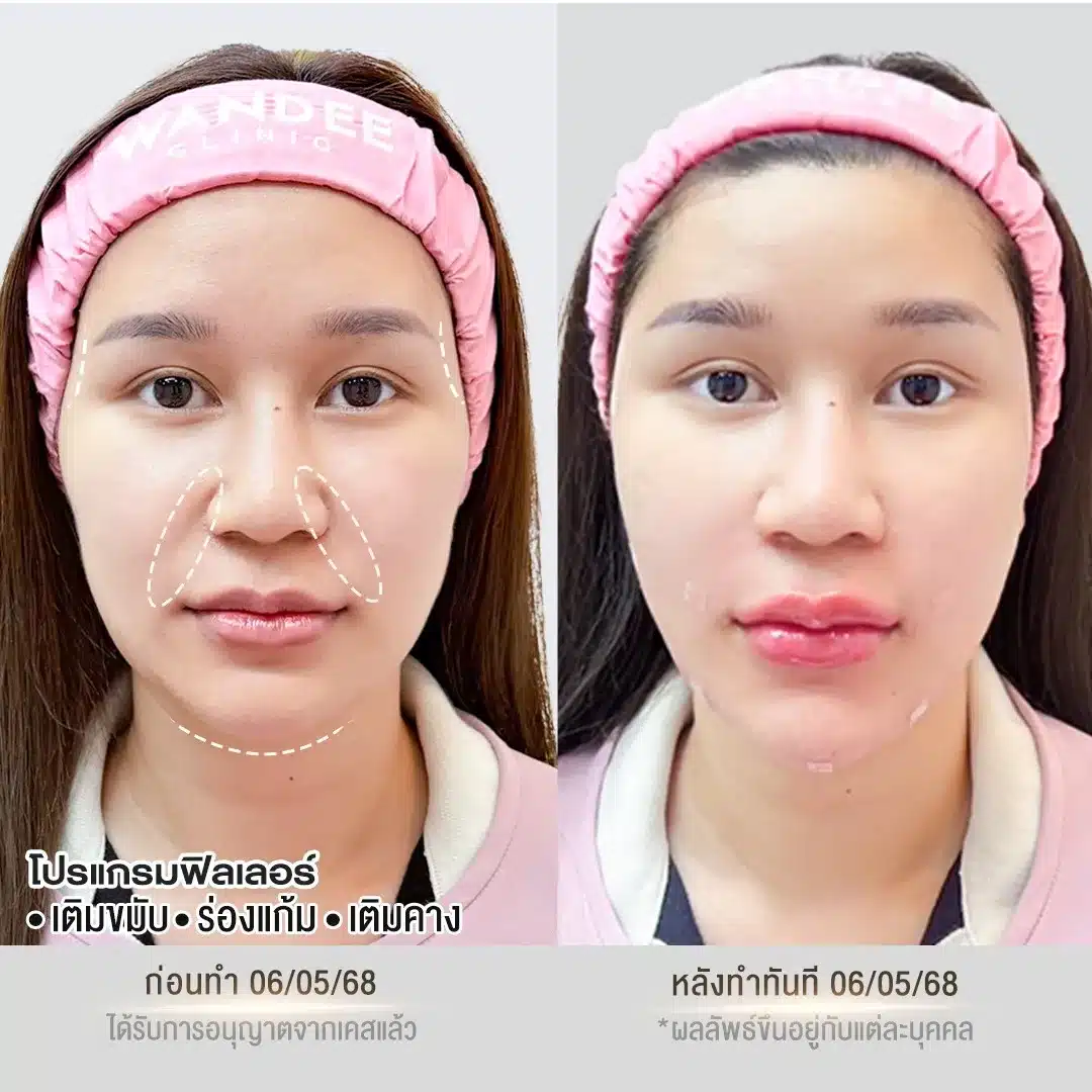 รีวิวฟิลเลอร์