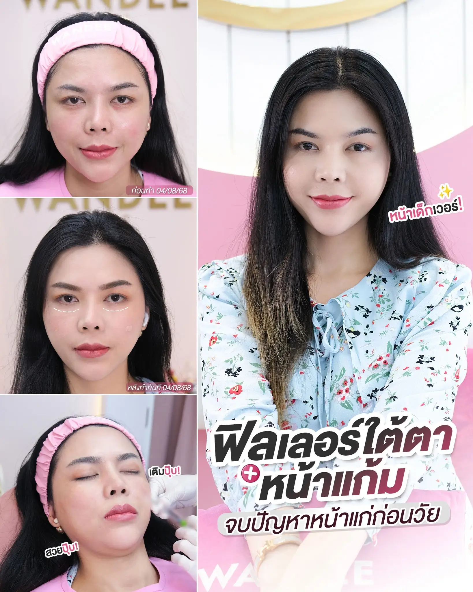 เติมใต้ตา + หน้าแก้ม