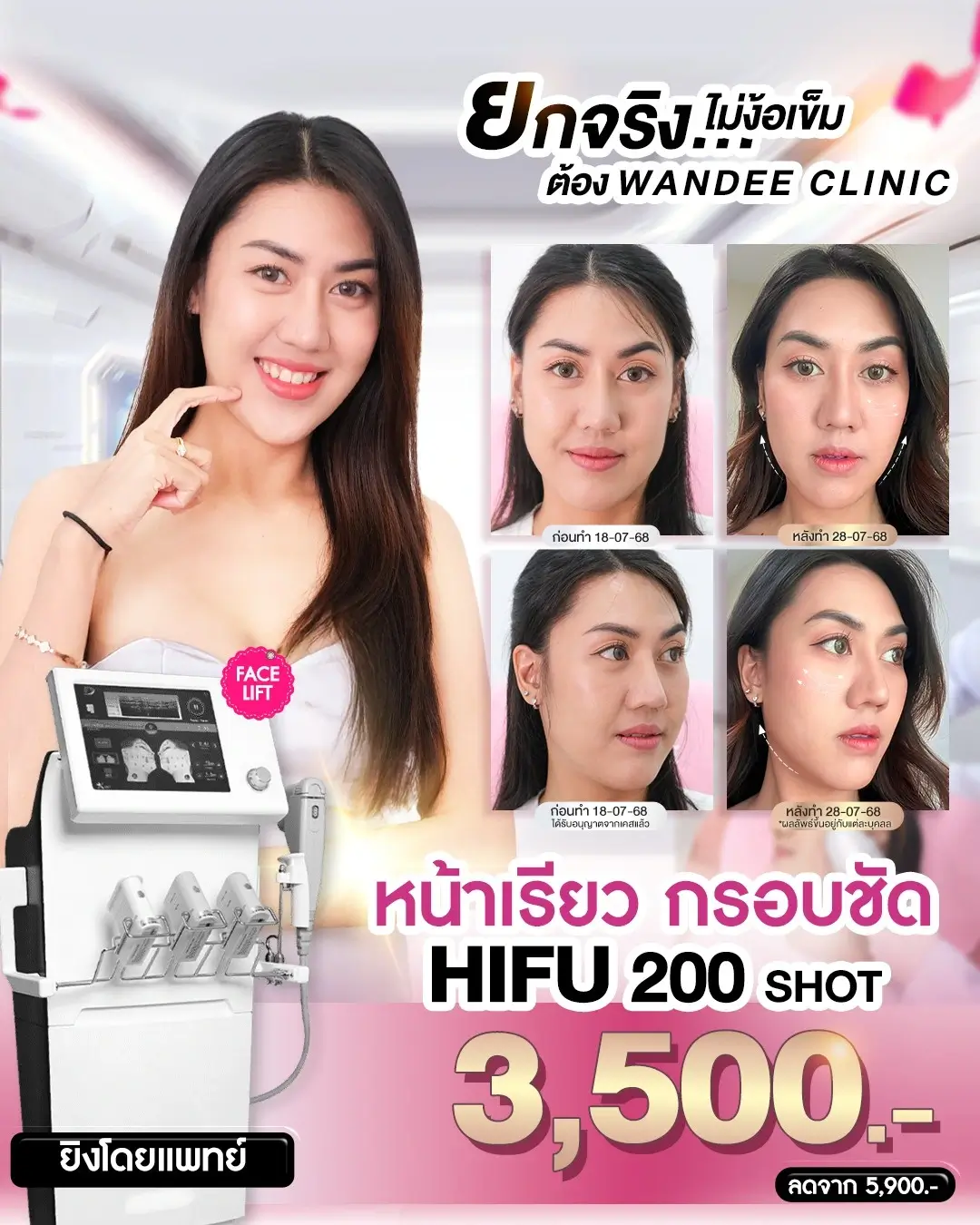 พียง 𝟯𝟱𝟬𝟬 จาก 𝟱,𝟵𝟬𝟬 หน้าเรียว กรอบชัด ด้วย 𝗛𝗜𝗙𝗨 ราคาพิเศษ