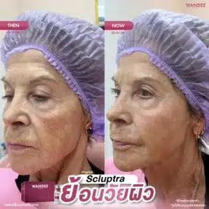 𝗦𝗰𝘂𝗹𝗽𝘁𝗿𝗮 ย้อนวัยให้ผิว