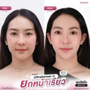 โปรแกรม 𝗨𝗹𝘁𝗿𝗮𝗳𝗼𝗿𝗺𝗲𝗿 𝗜𝗜𝗜 ยกหน้าเรียว กรอบชัด 💖 อยากหน้าแน่น ดูเด็กแบบนี้ ทักมาเลยค่า