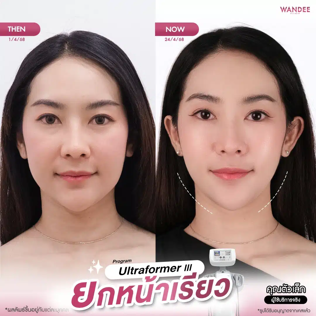 โปรแกรม 𝗨𝗹𝘁𝗿𝗮𝗳𝗼𝗿𝗺𝗲𝗿 𝗜𝗜𝗜 ยกหน้าเรียว กรอบชัด 💖 อยากหน้าแน่น ดูเด็กแบบนี้ ทักมาเลยค่า