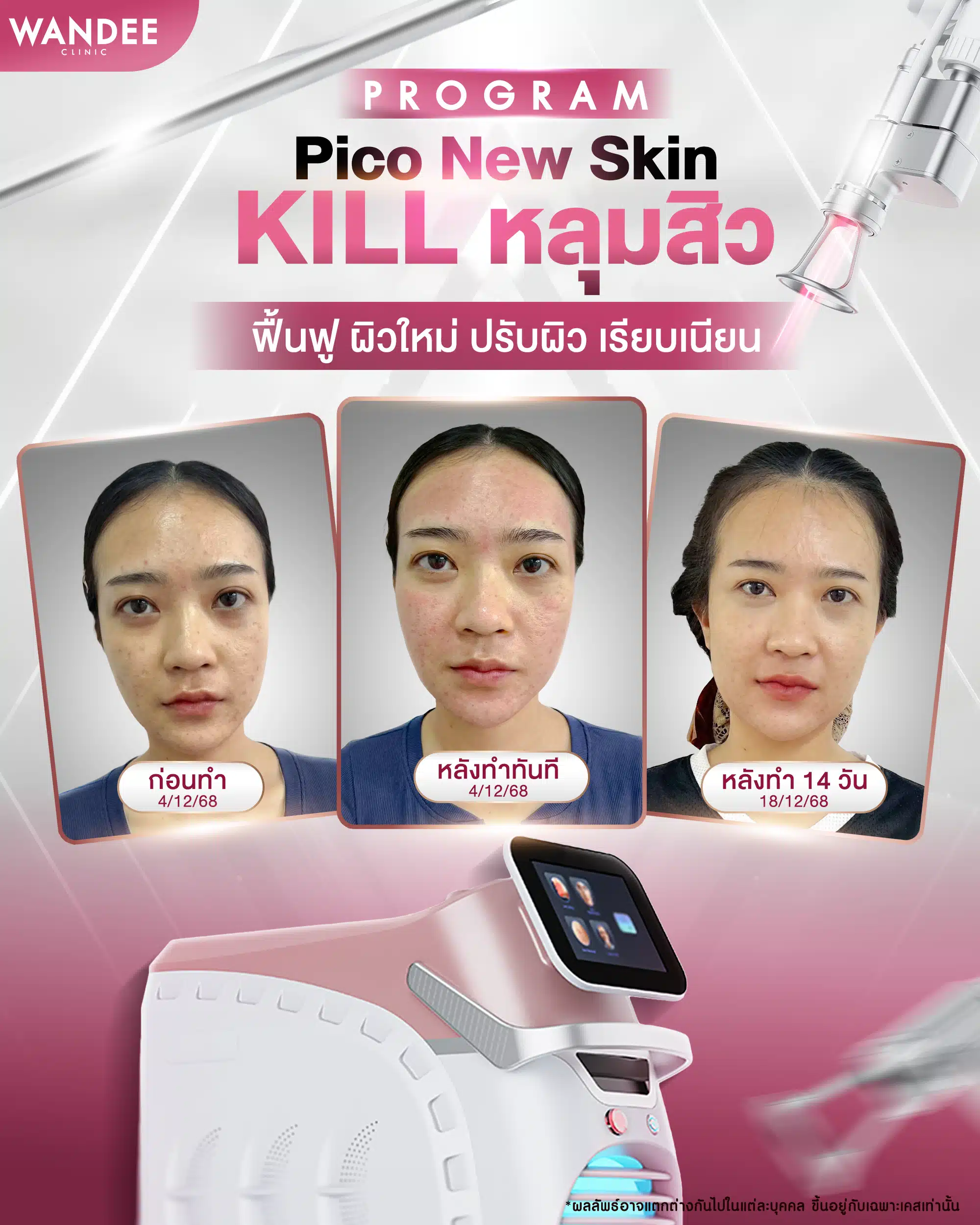 pico laser