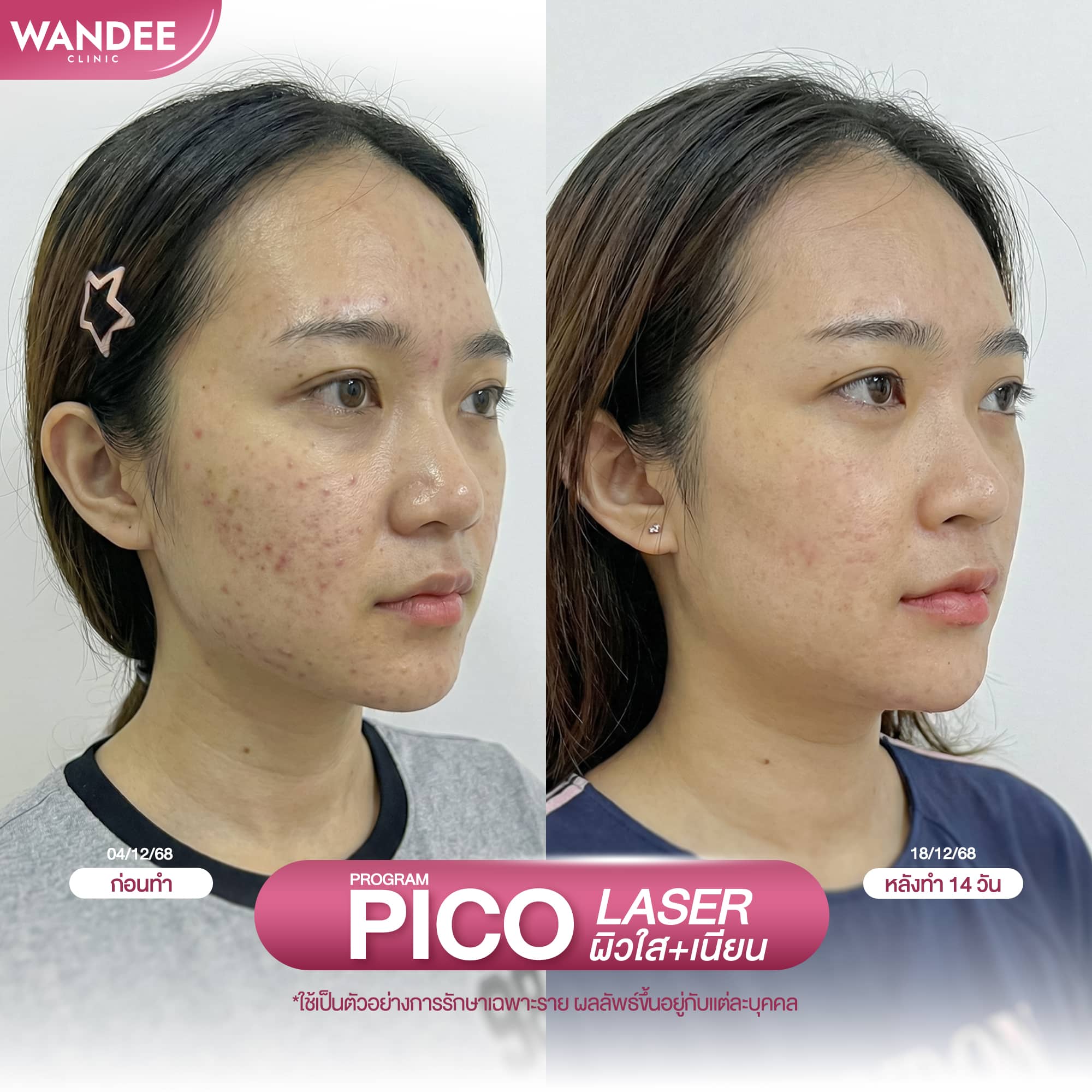 pico laser