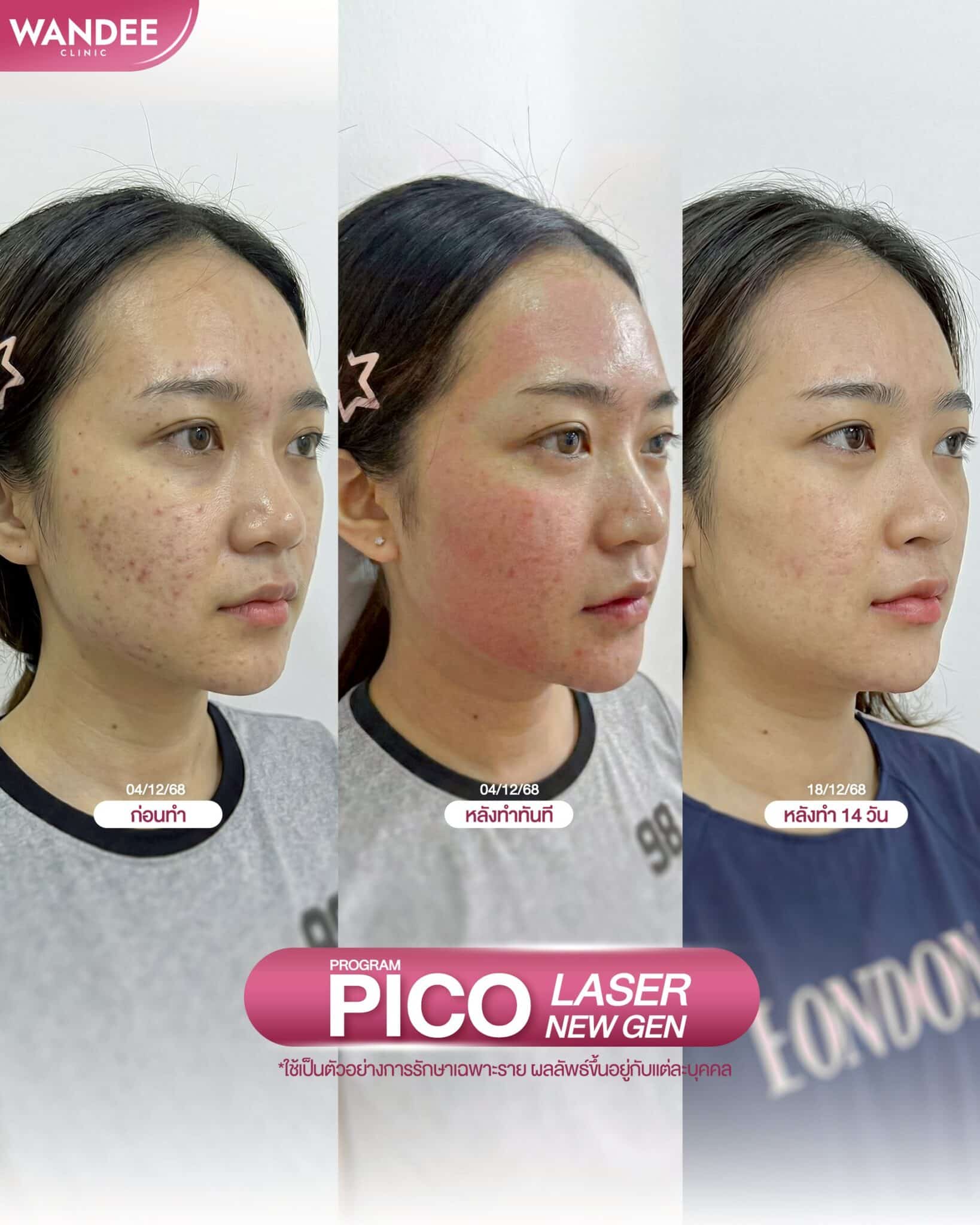 pico laser