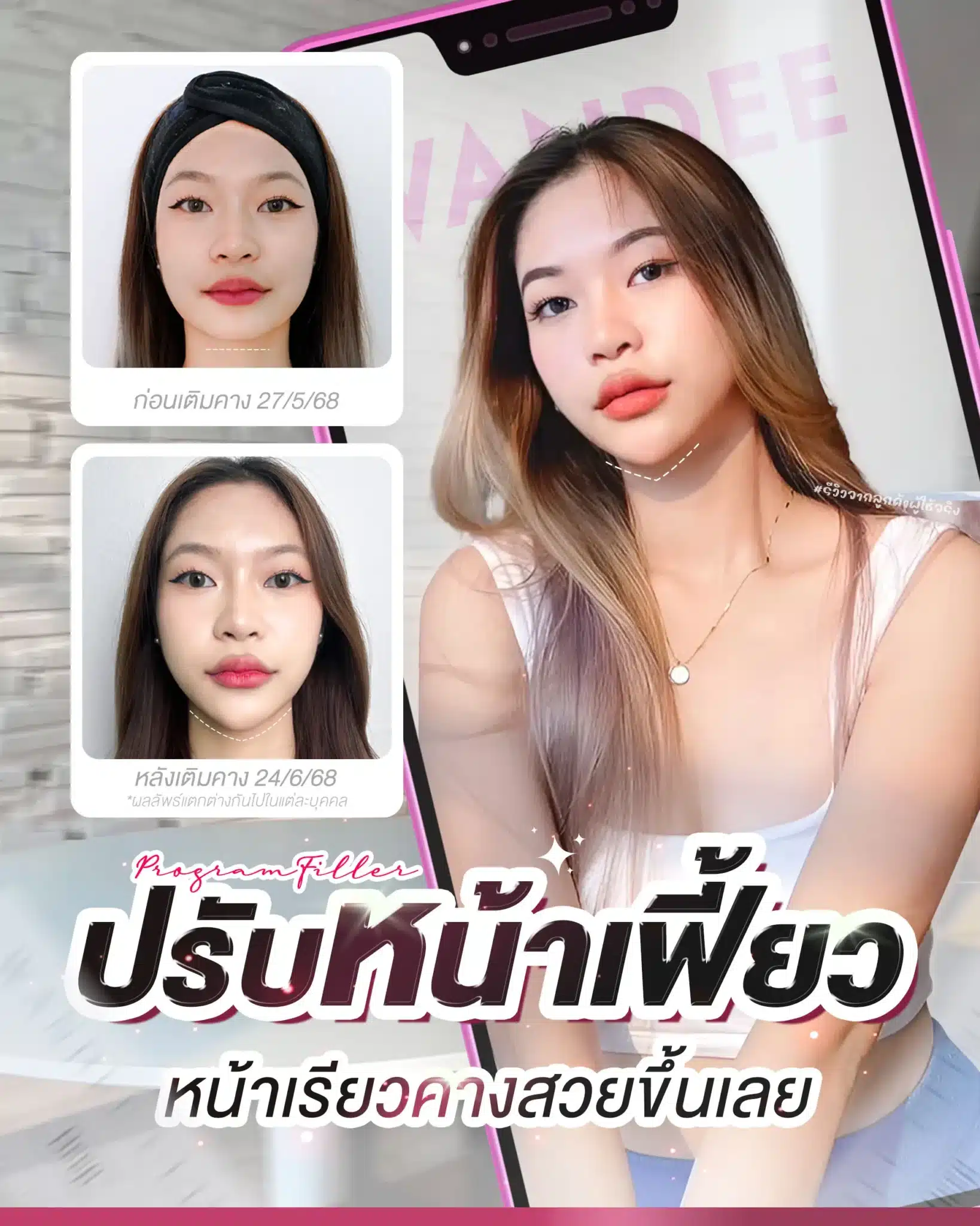 รีวิว ฟิลเลอร์คาง Wandee Clinic
