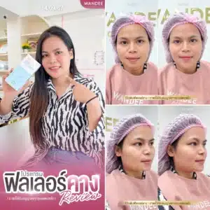 รีวิว ฟิลเลอร์คาง Wandee Clinic