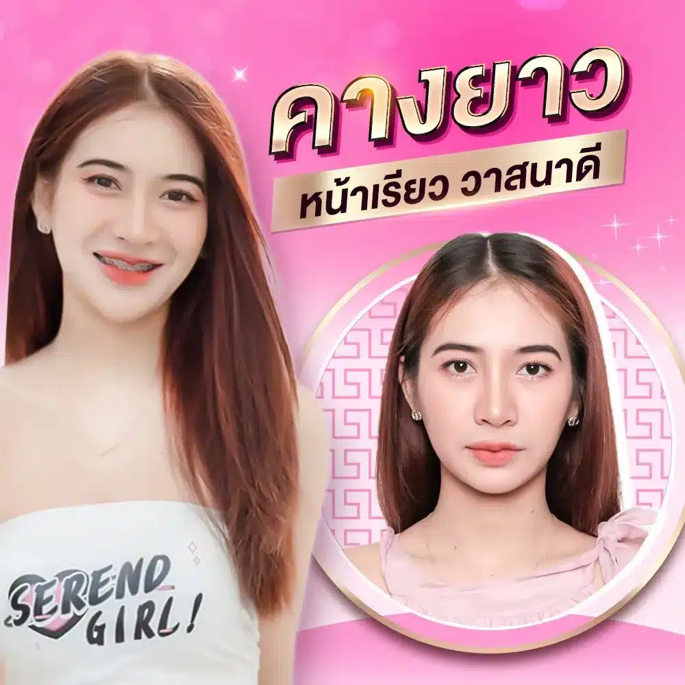 รีวิว ฟิลเลอร์คาง Wandee Clinic