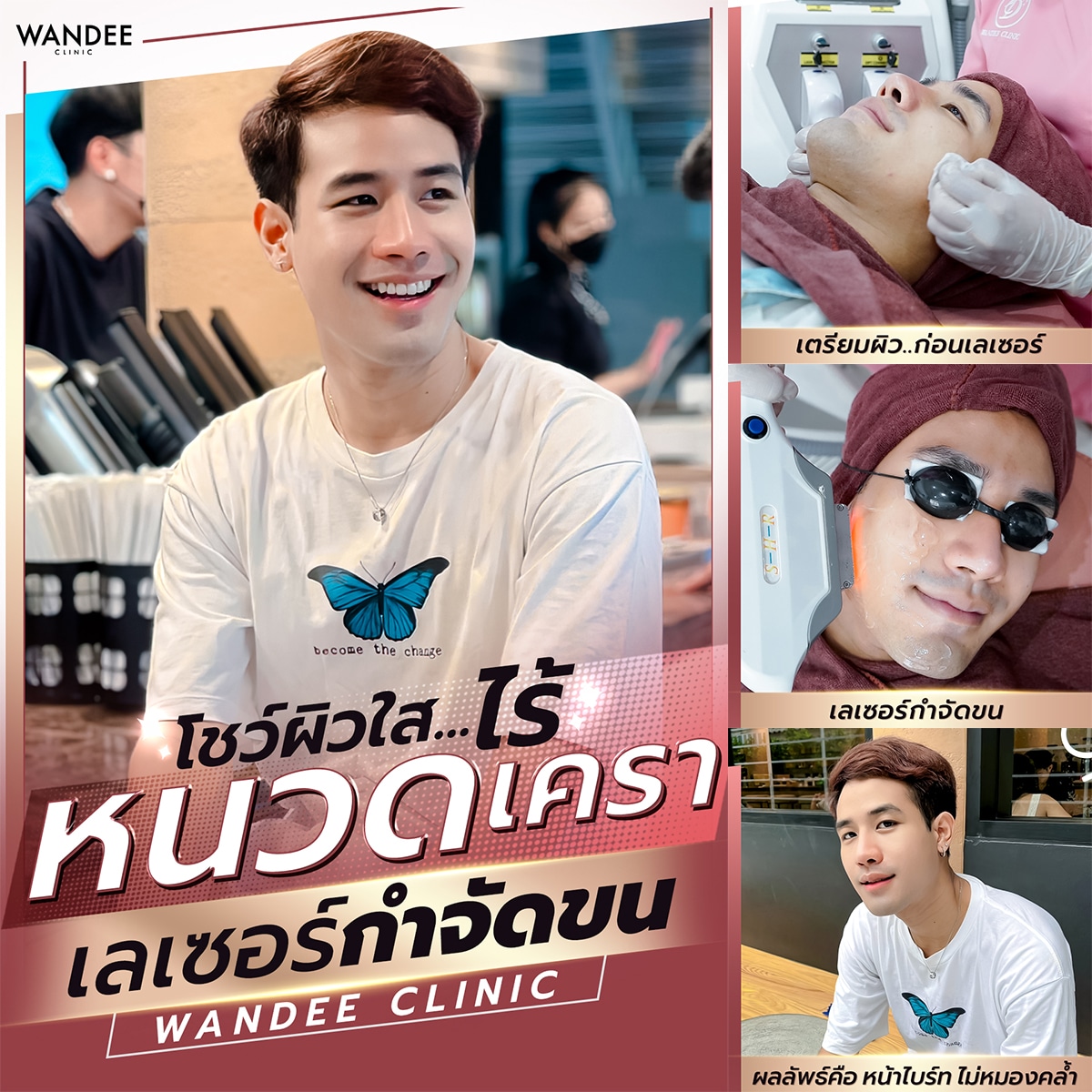 เลเซอร์
