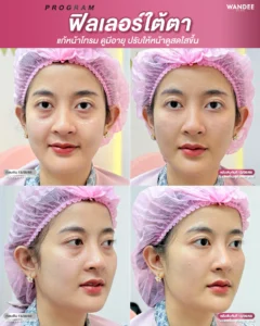 ฟิลเลอร์ใต้ตา