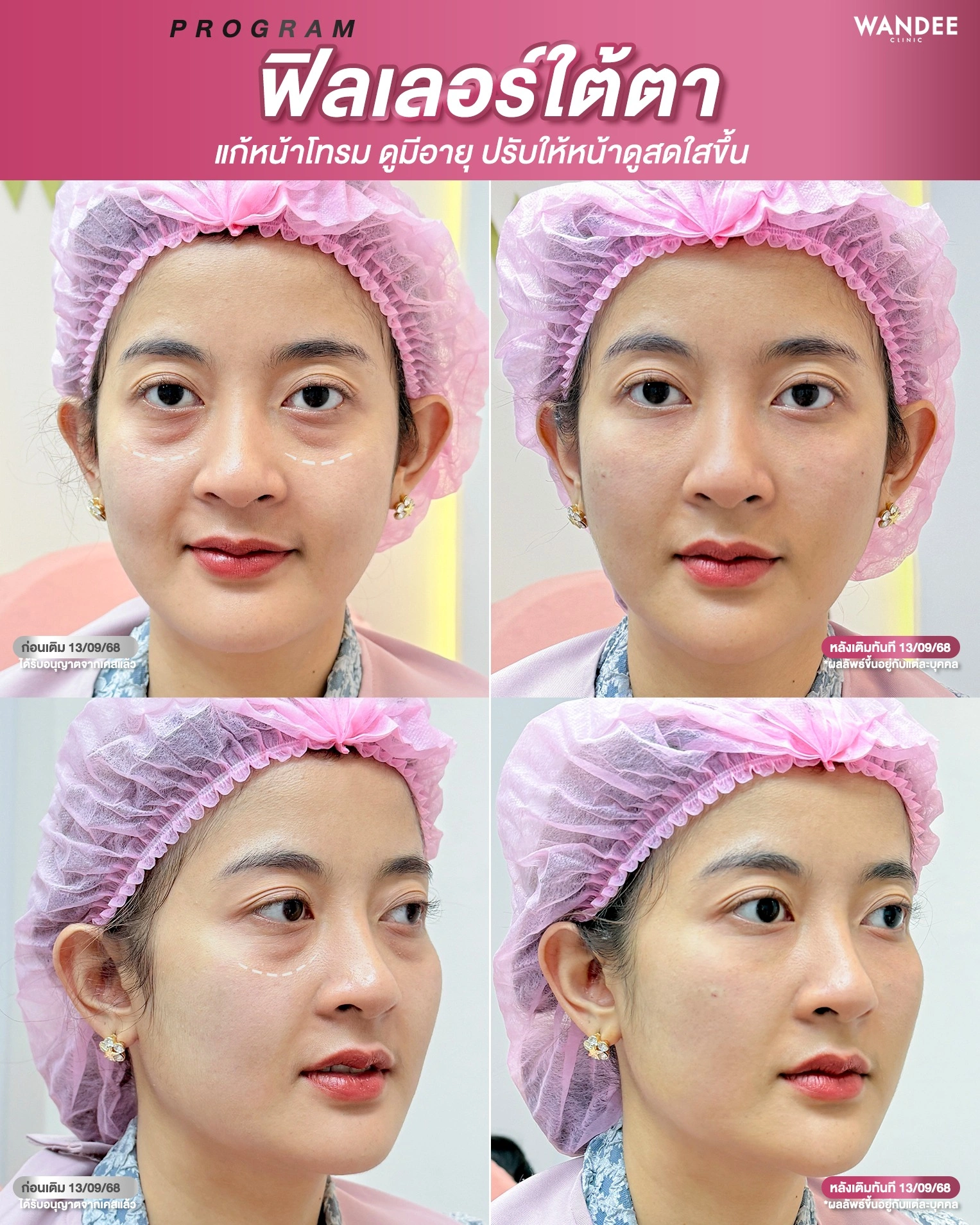 ฟิลเลอร์ใต้ตา