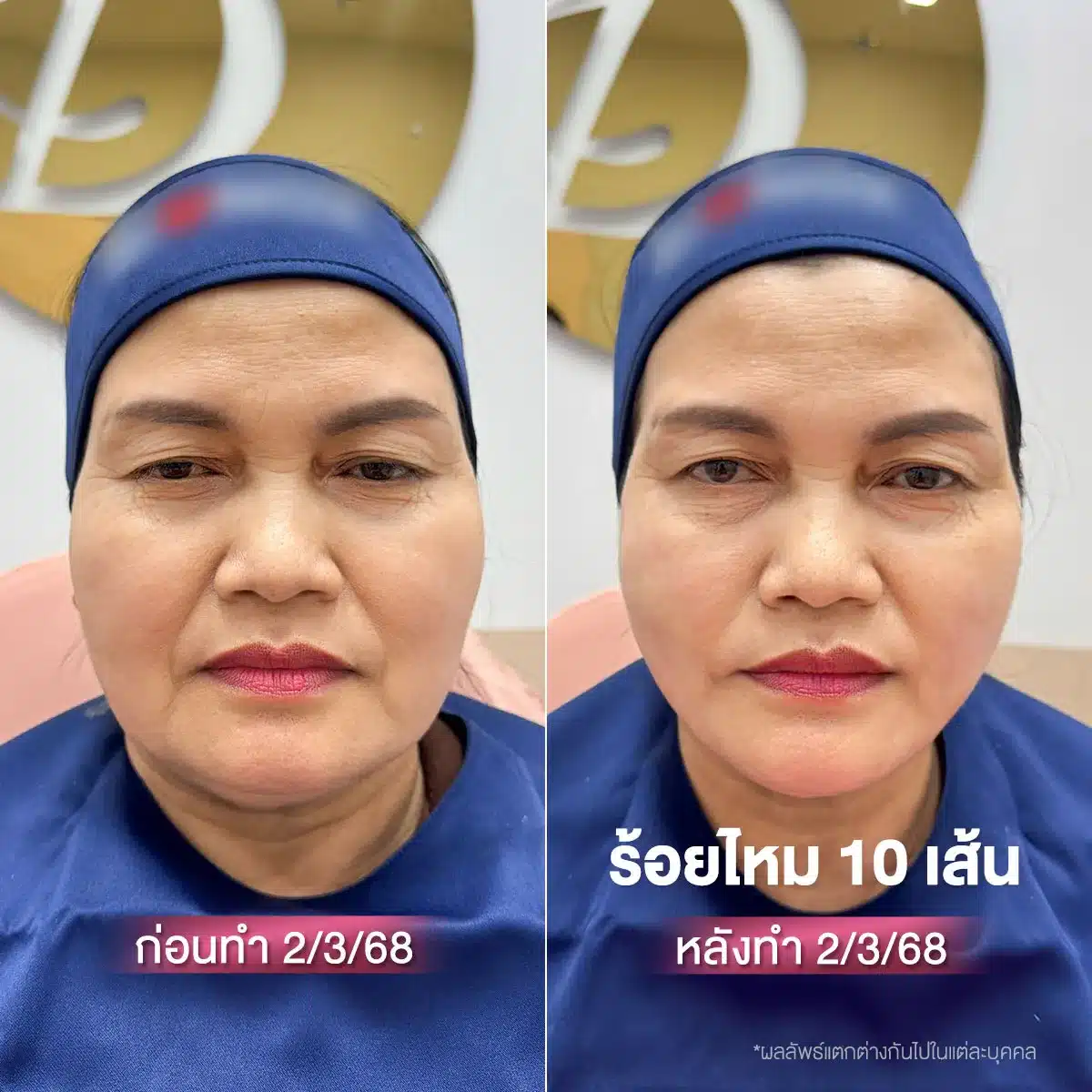 รีวิว ร้อยไหม ลูกค้า Wandee clinic