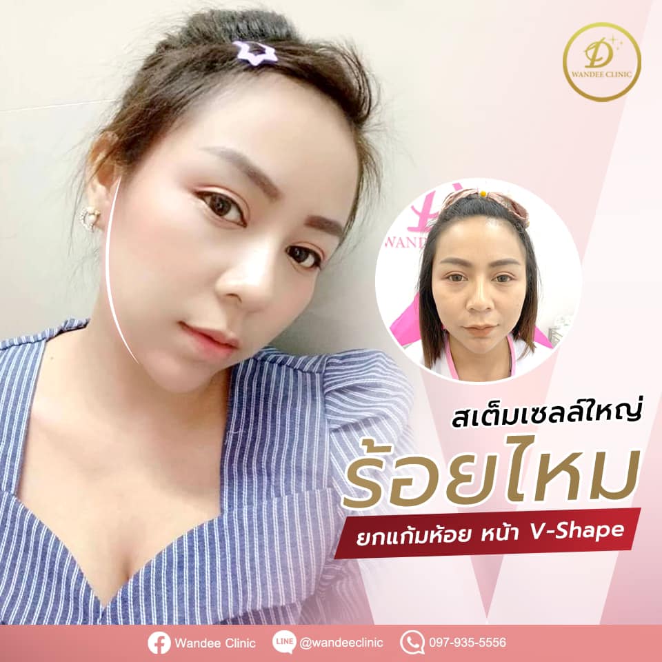 รีวิวร้อยไหม