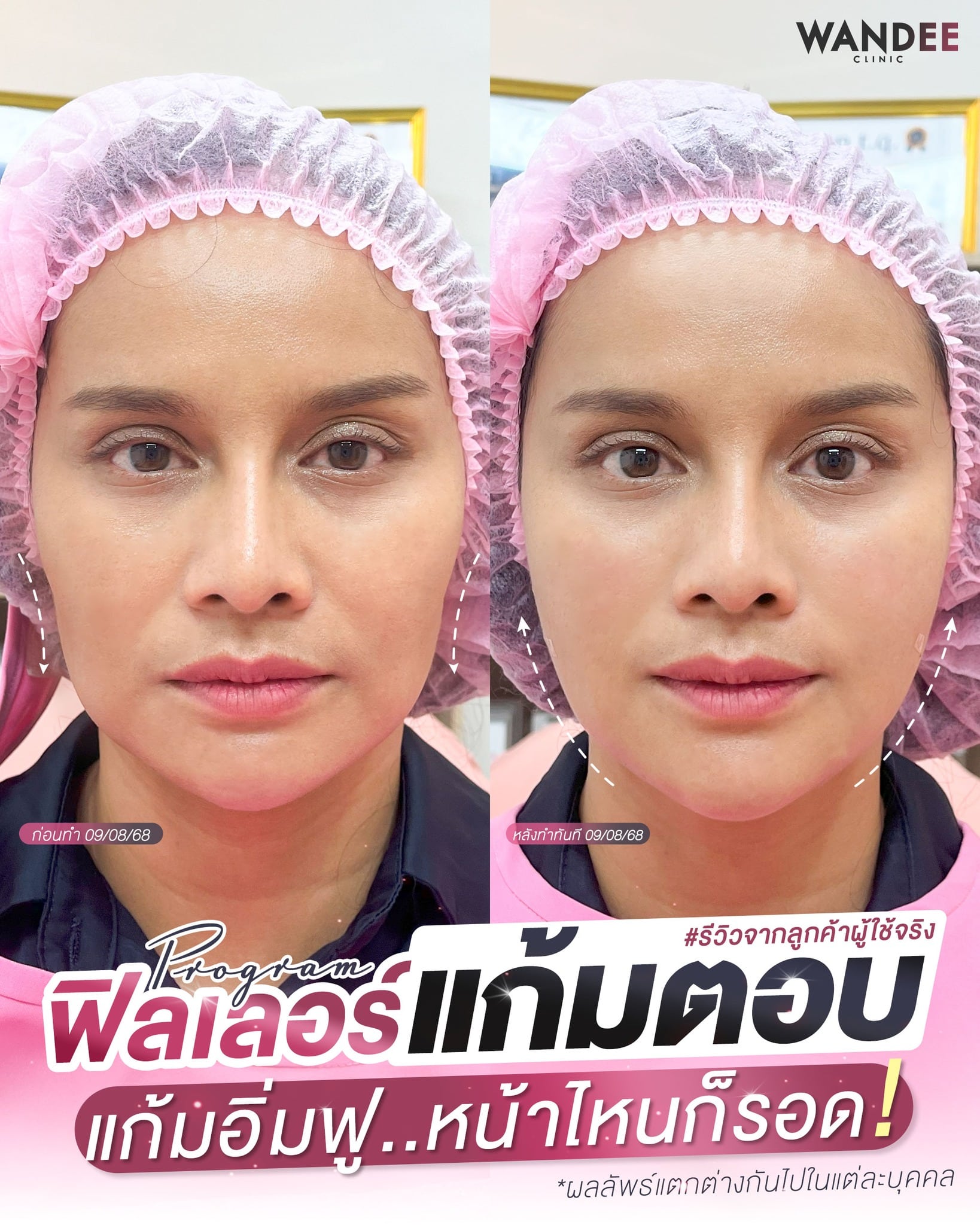 รีวิวฉีดฟิลเลอร์ แก้มตอบ