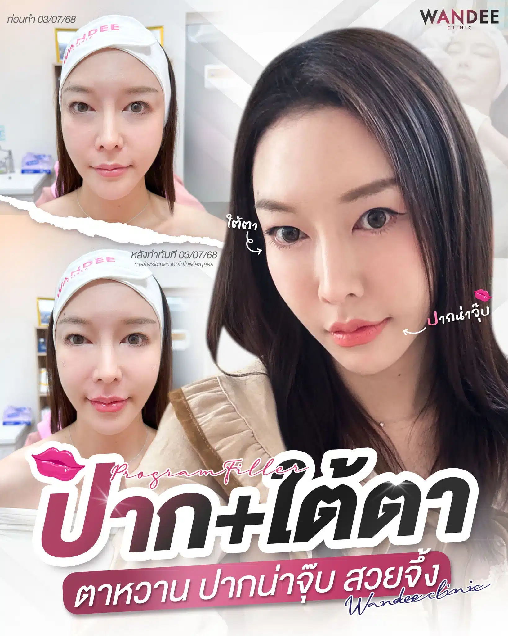 รีวิวฟิลเลอร์ ปาก+ใต้ตา