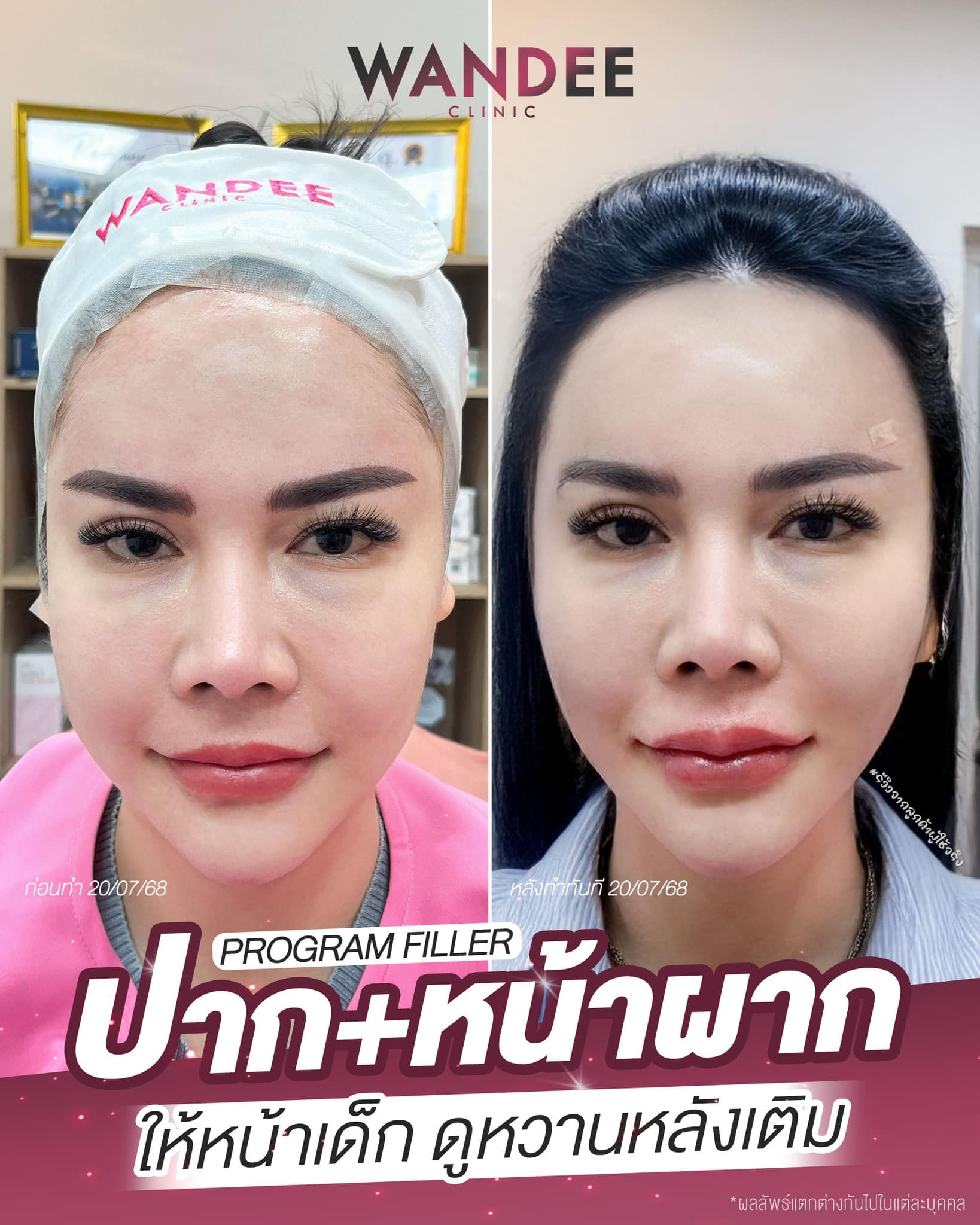รีวิวฟิลเลอร์ปากและหน้าผาก