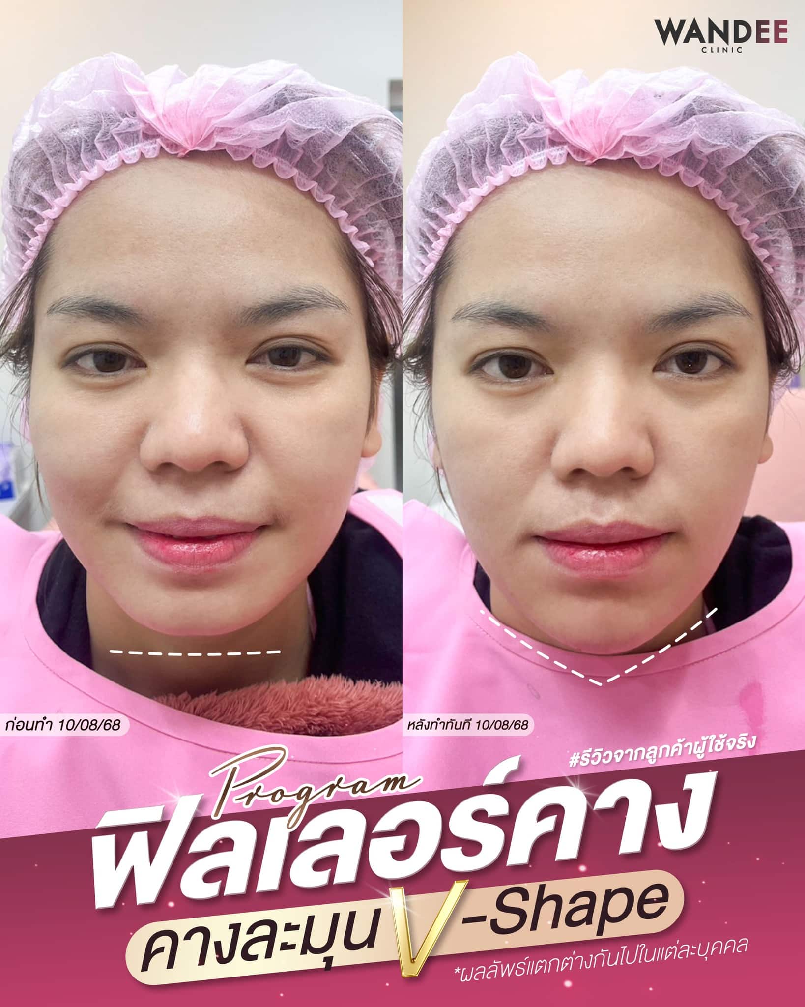 รีวิวฟิลเลอร์คาง