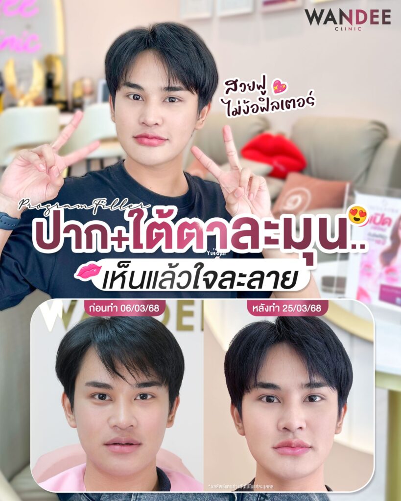 ฟิลเลอร์ใต้ตา