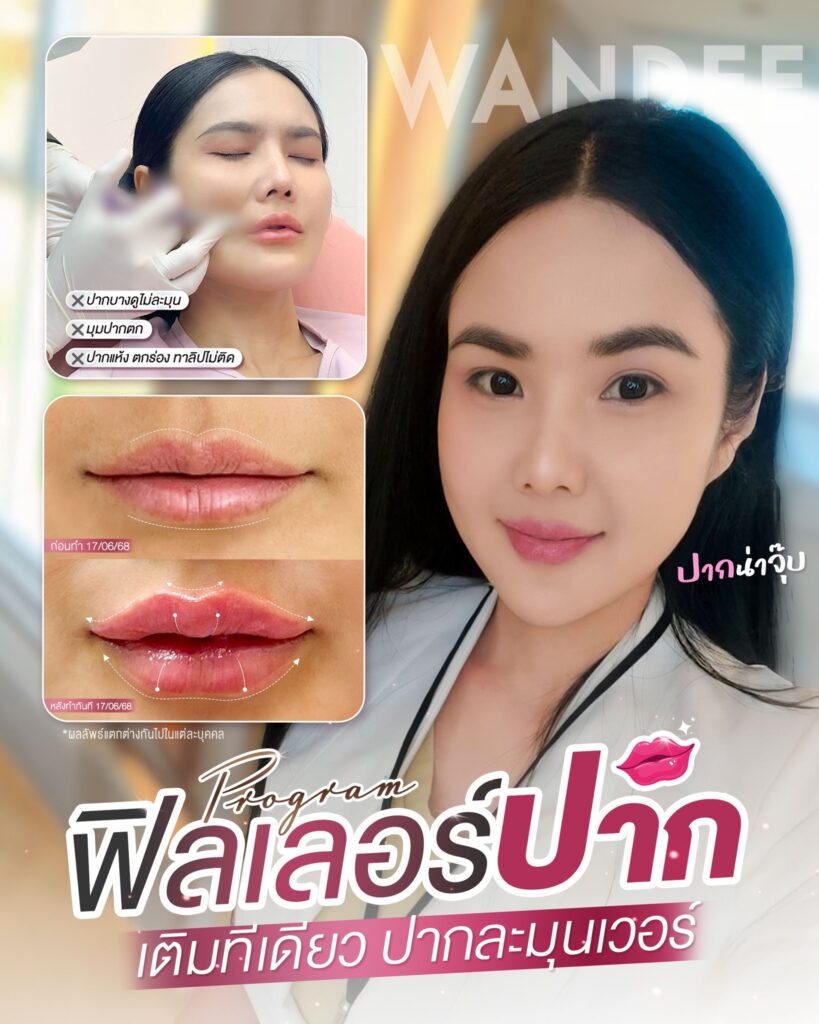 ฟิลเลอร์ปาก