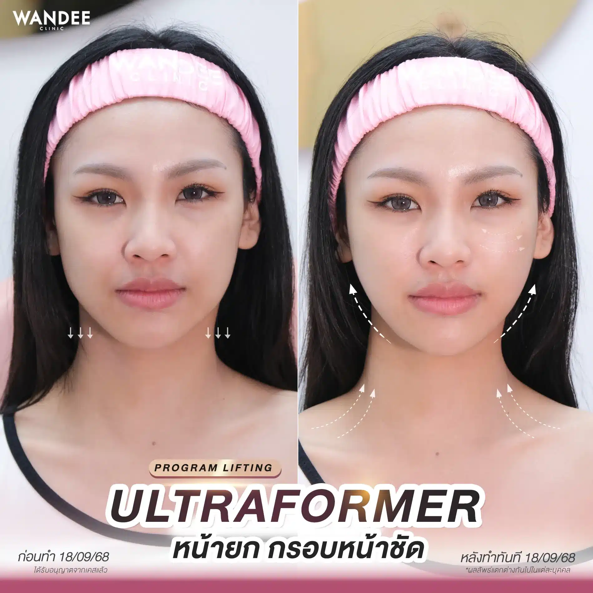 รีวิว Ultraformer Wandee Clinic