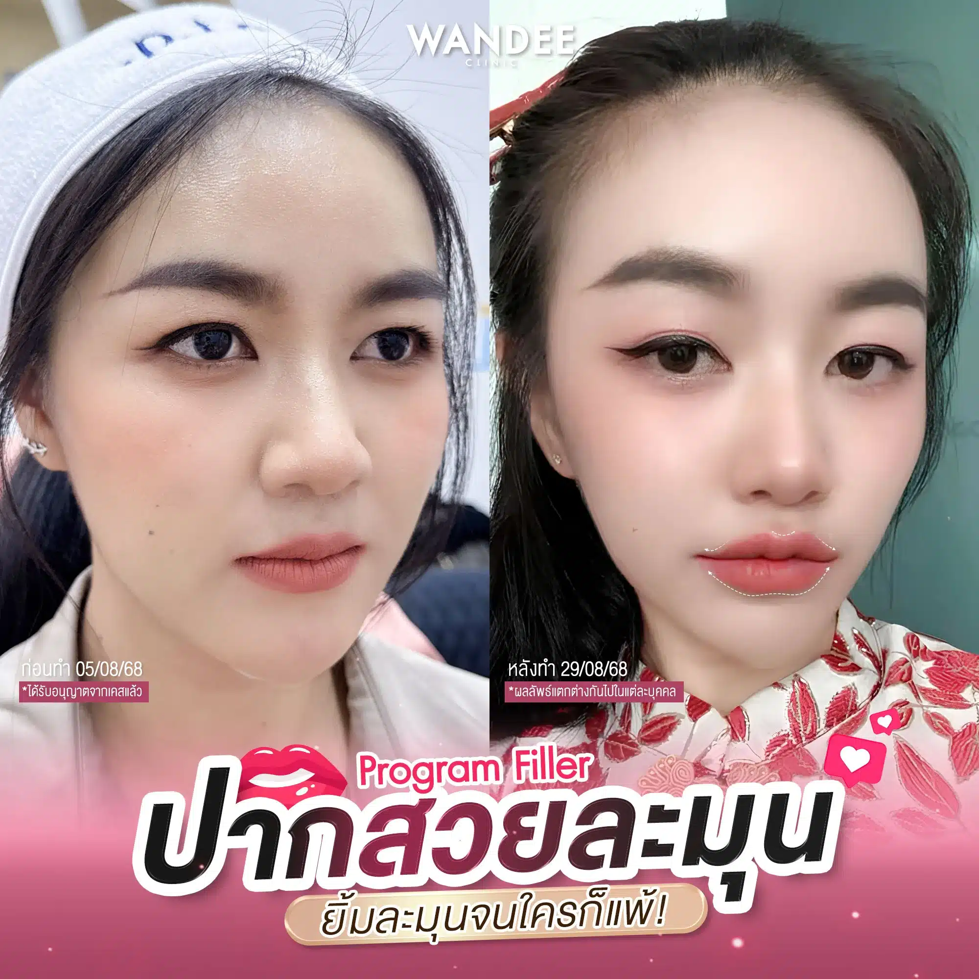 รีวิวฟิลเลอร์ปาก Wandee Clinic