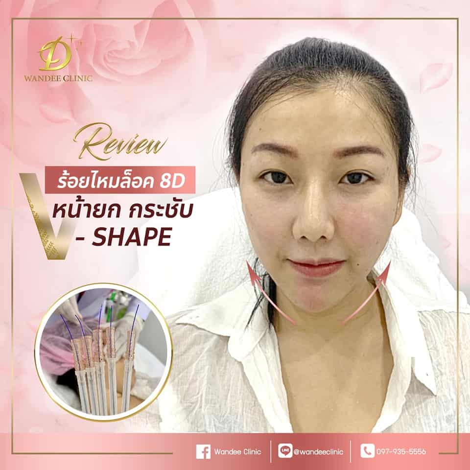 รีวิวร้อยไหม