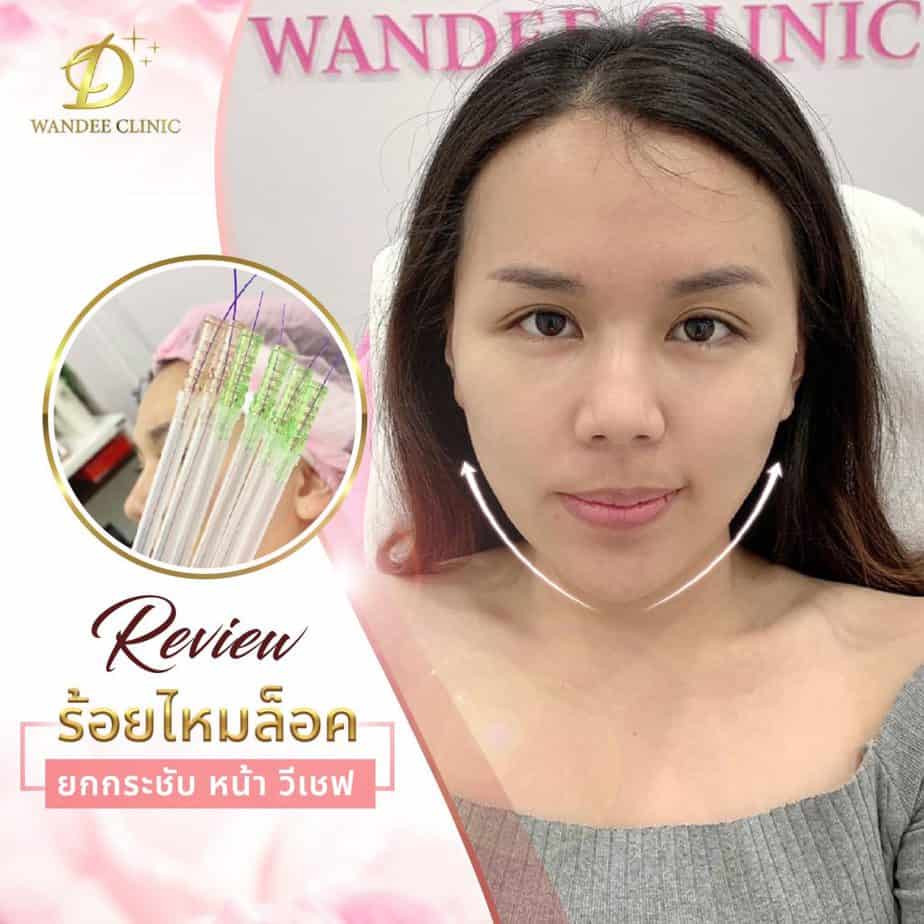 รีวิวร้อยไหม