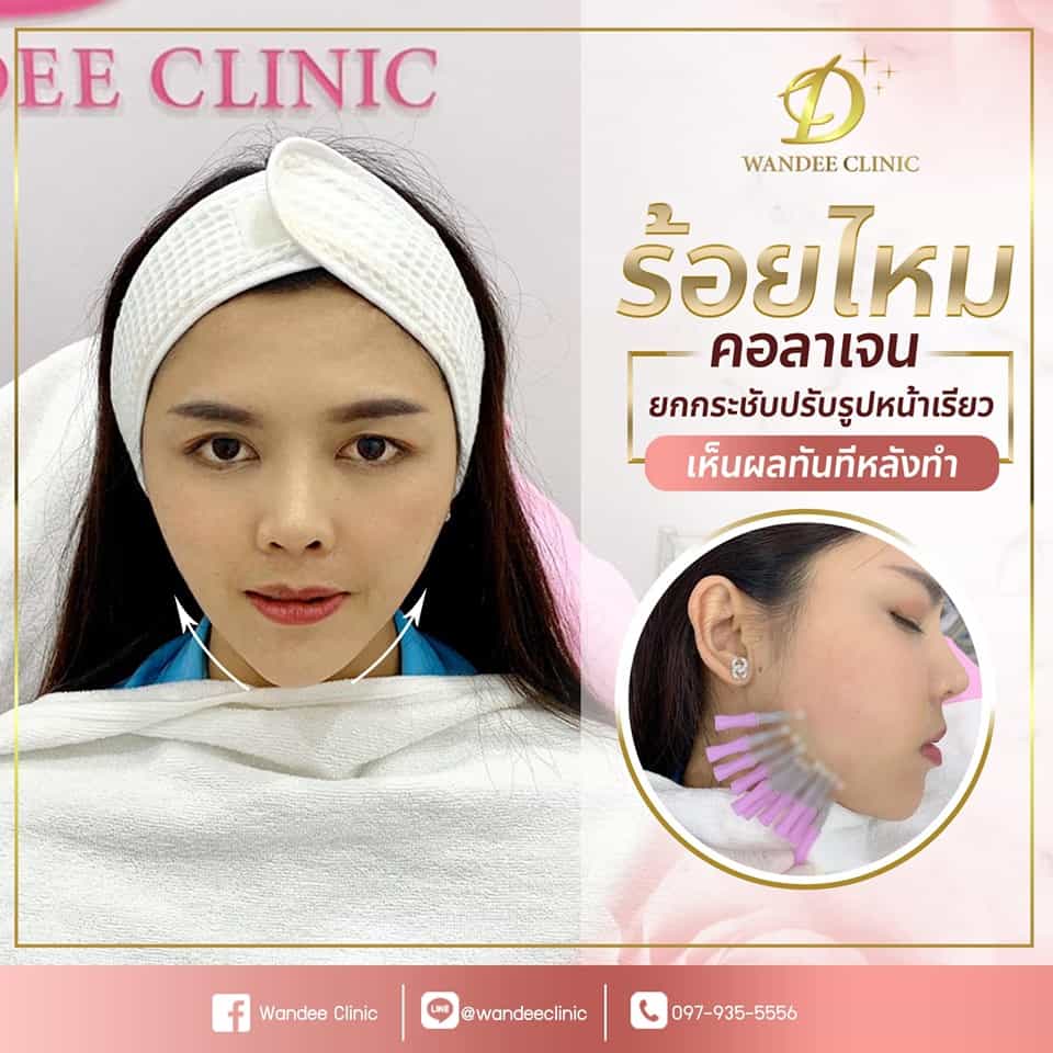 รีวิวร้อยไหม