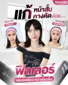 รีวิวฉีดฟิลเลอร์ จากวันดัคลินิก