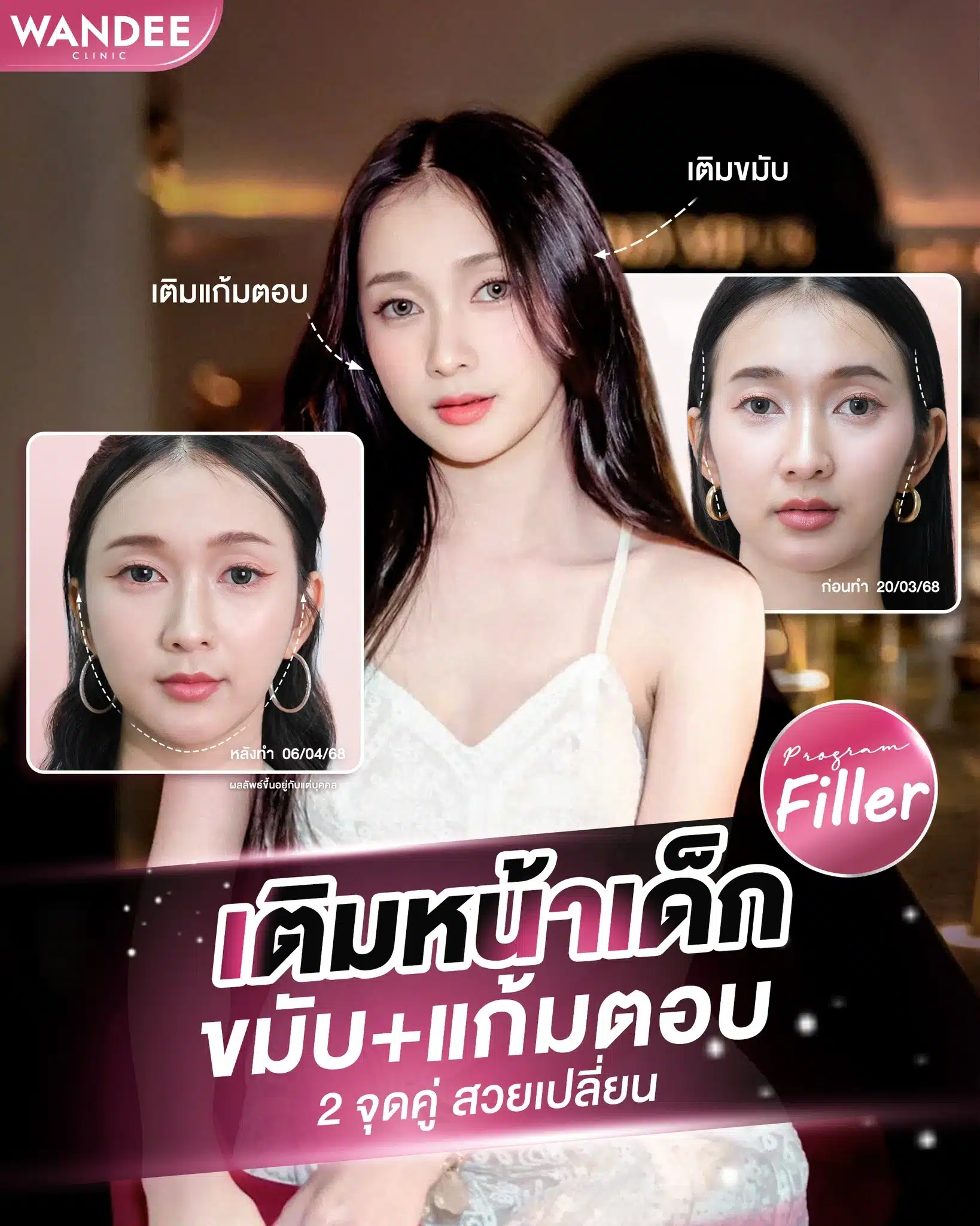 ฉีดฟิลเลอร์เติมหน้าเด็ก