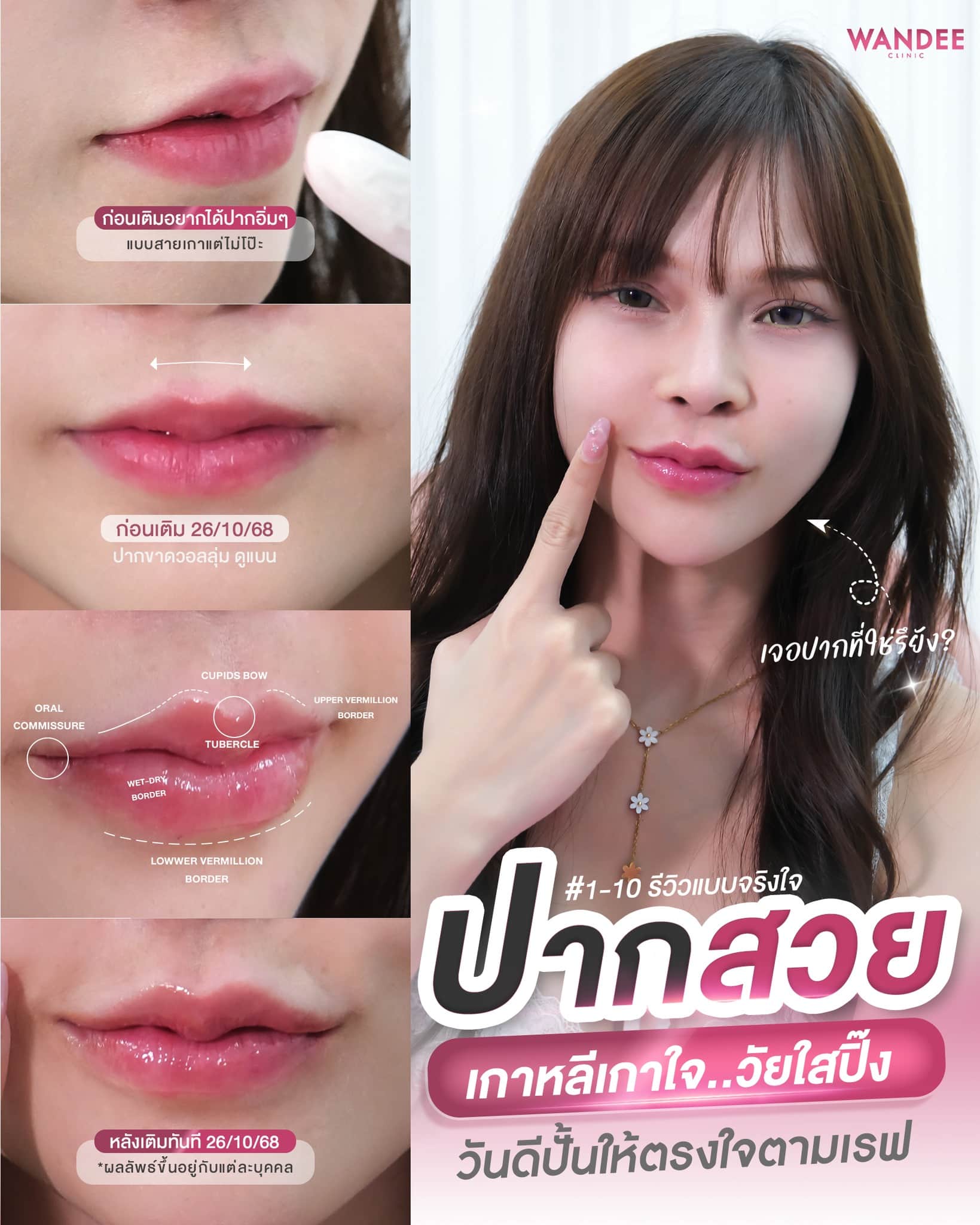 วีวิวฟิลเลอร์ ปากสวย