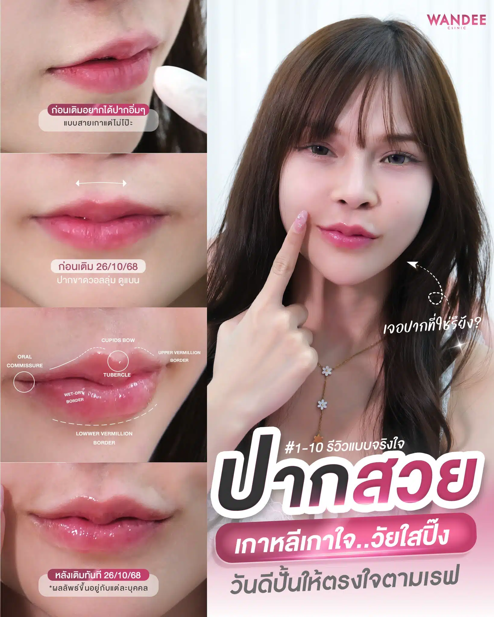 วีวิวฟิลเลอร์ ปากสวย