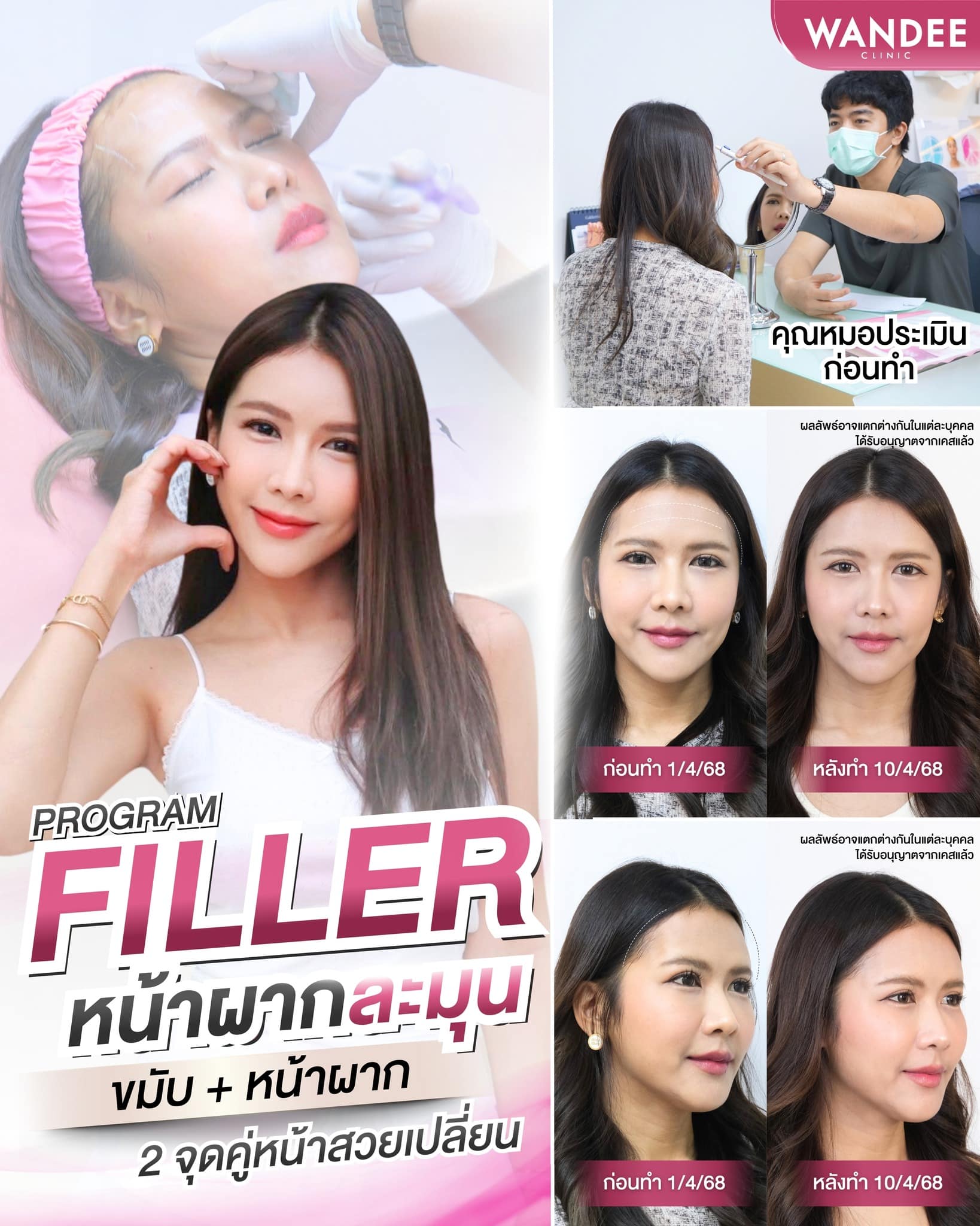 รีวิวโปรแกรมฟิลเลอร์ จากวันดีคลินิก