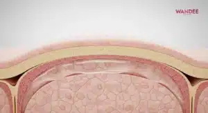 ภาพ 3D แสดงฟิลเลอร์ HA กระจายตัวในชั้นที่เหมาะสม ผิวเรียบเนียน