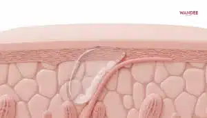 ภาพสามมิติแสดงฟิลเลอร์ HA วางในชั้นผิวที่เหมาะสมและกลืนกับเนื้อเยื่อเพื่อผลลัพธ์ดูธรรมชาติ