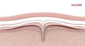 ภาพจำลองการทำงานของฟิลเลอร์ใต้ผิวหน้า แสดงชั้นผิวและการพยุงผิวอย่างเป็นธรรมชาติในโทนคลินิกความงาม