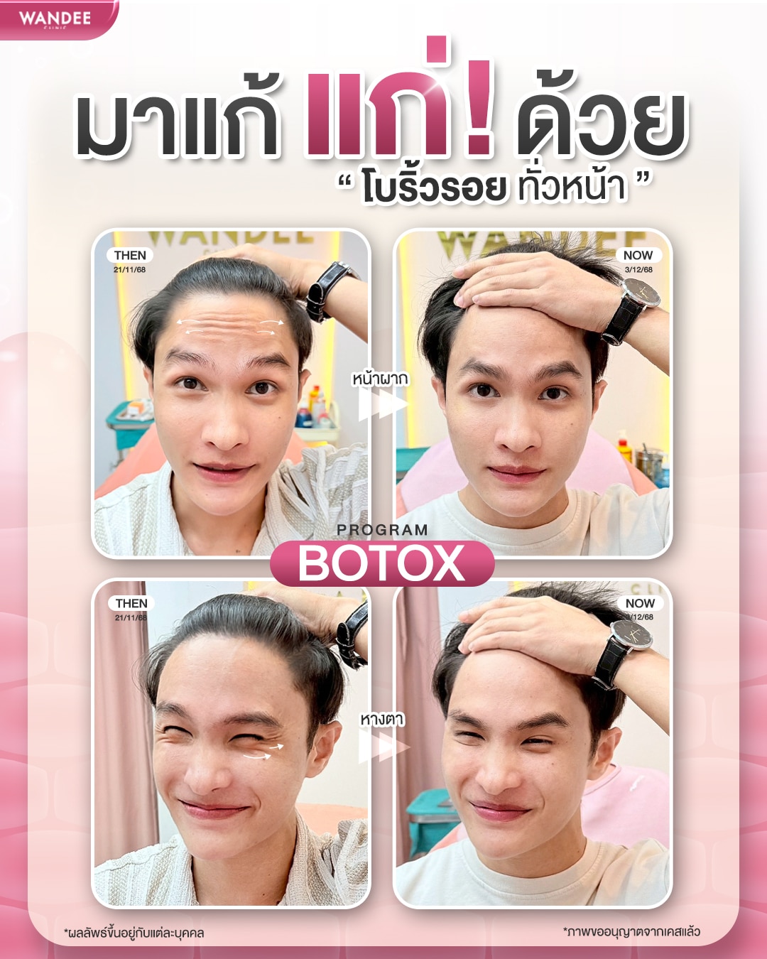 โบท็อกซ์