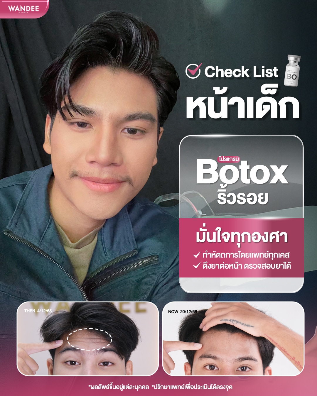 โบท็อกซ์