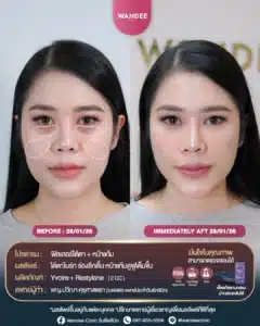 ใต้ตาลึก หน้าแก้มตอบ ทำให้หน้าดูโทรมไม่สดใส❗ แก้ได้ด้วย