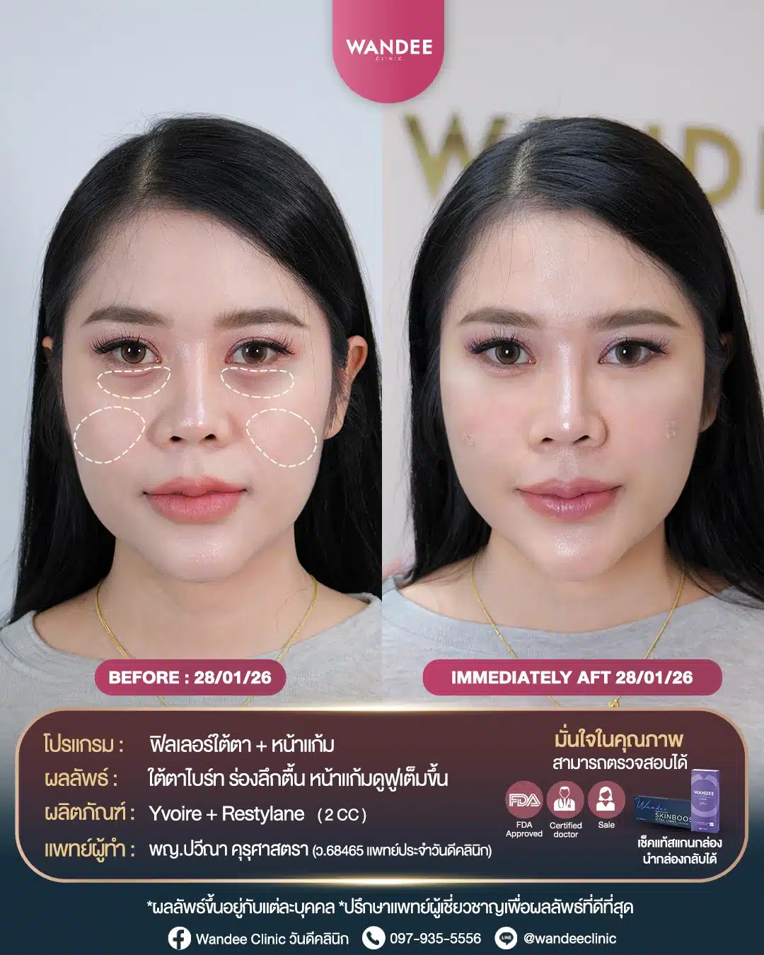 ใต้ตาลึก หน้าแก้มตอบ ทำให้หน้าดูโทรมไม่สดใส❗ แก้ได้ด้วย