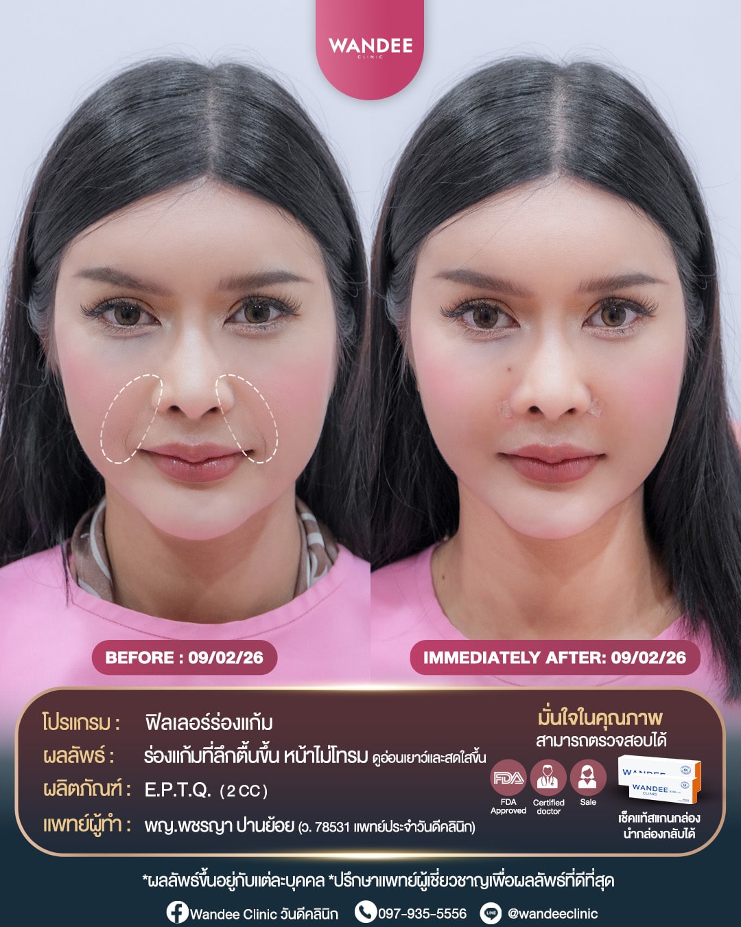 Deep nasolabial folds