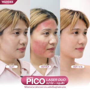 rough skin