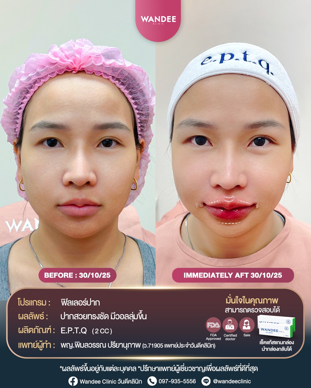 ปากคว่ำบาง